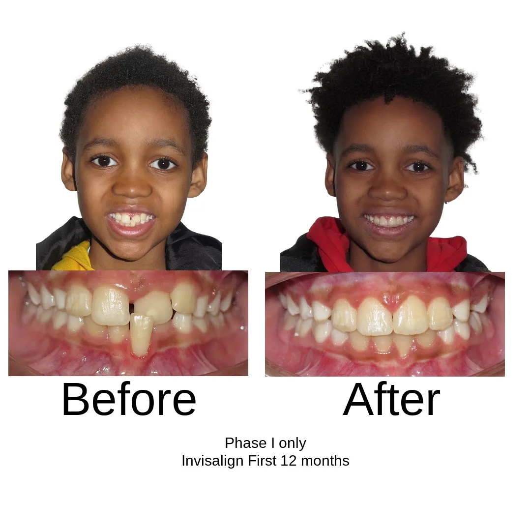 Before and after — Phase I only, Invisalign First 12 months