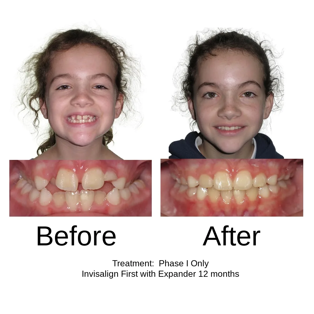 Before and after — Phase I only, Invisalign First with expander, 12 months