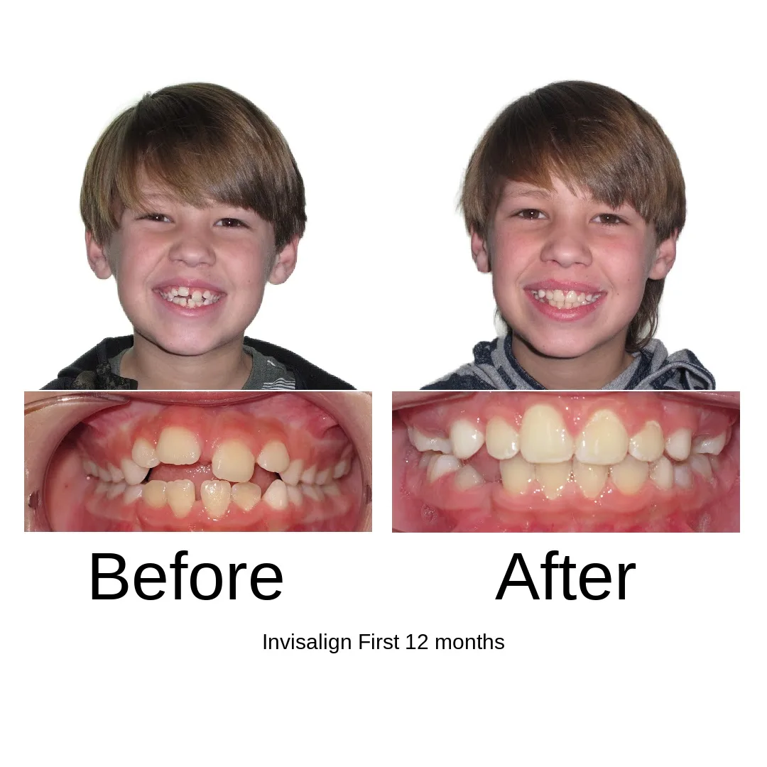 Before and after — Invisalign First, 12 months