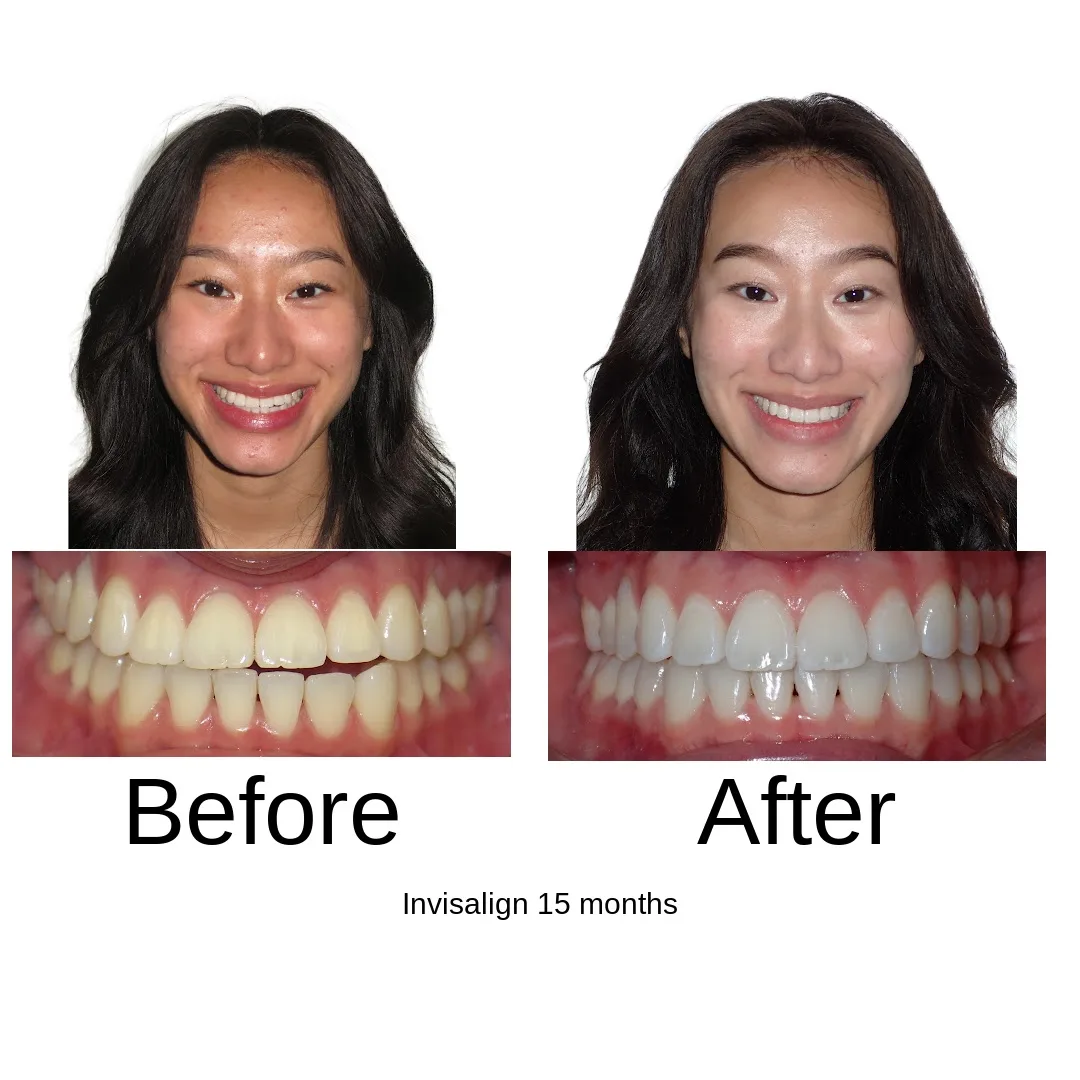 Before and after — Invisalign, 15 months