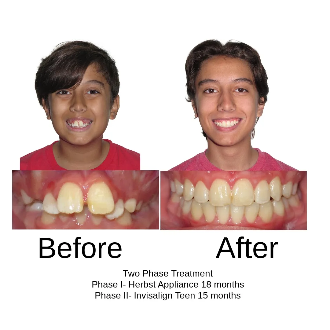 Before and after — two-phase, Herbst appliance 18 months then Invisalign Teen 15 months