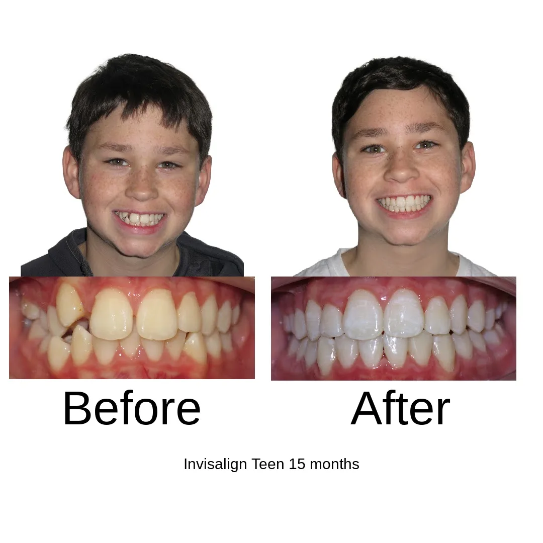 Before and after — Invisalign Teen, 15 months