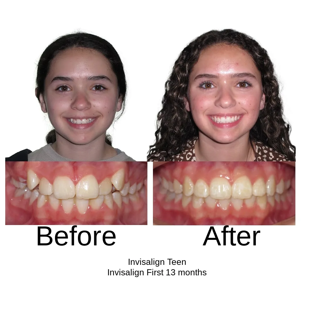 Before and after — Invisalign Teen with Invisalign First, 13 months