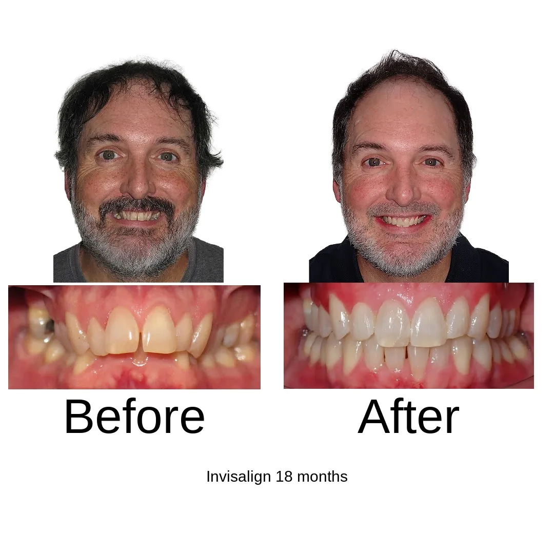 Before and after — adult Invisalign, 18 months