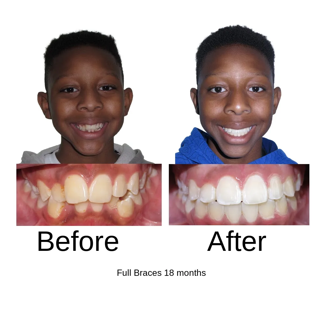 Before and after — full braces, 18 months