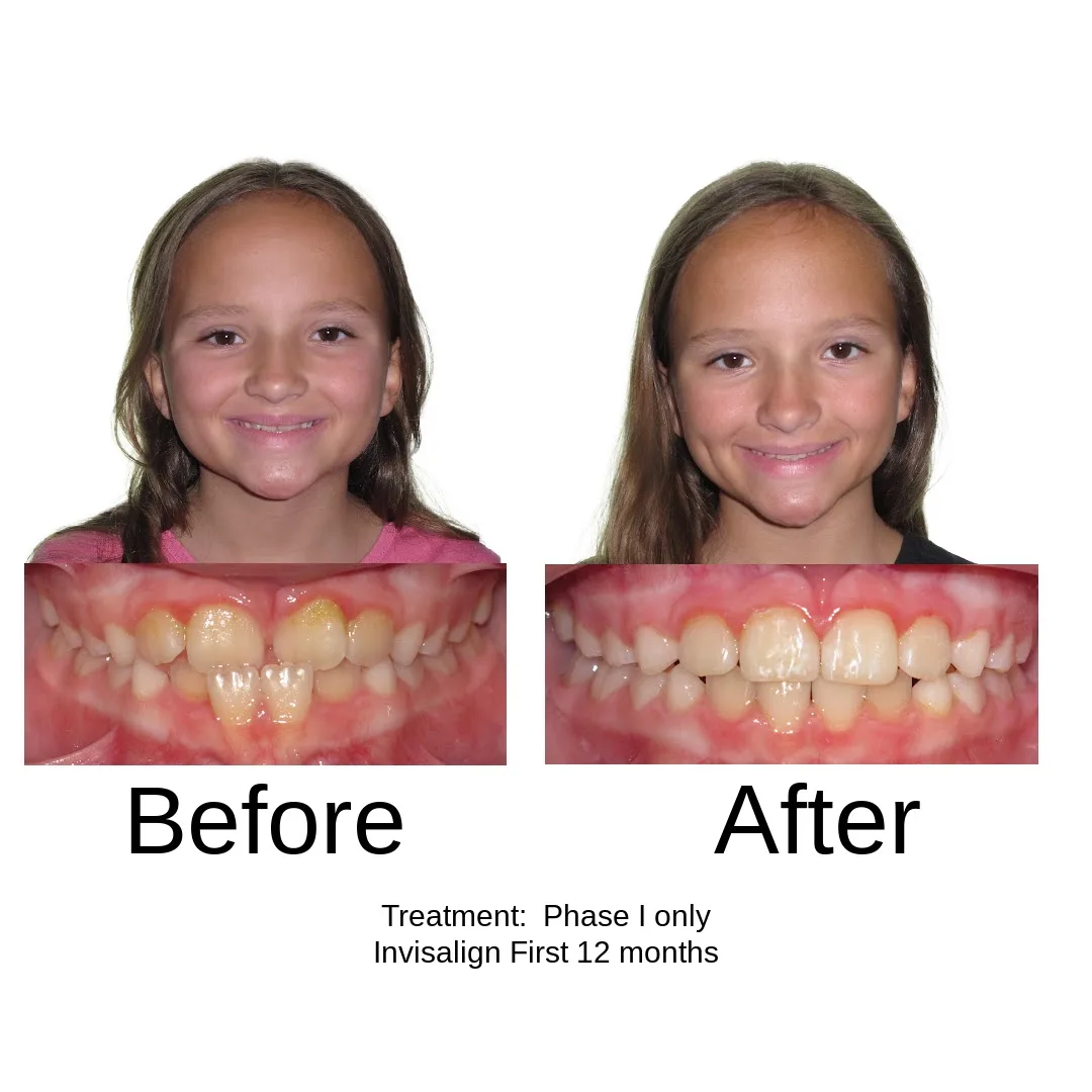 Before and after — Phase I only, Invisalign First 12 months