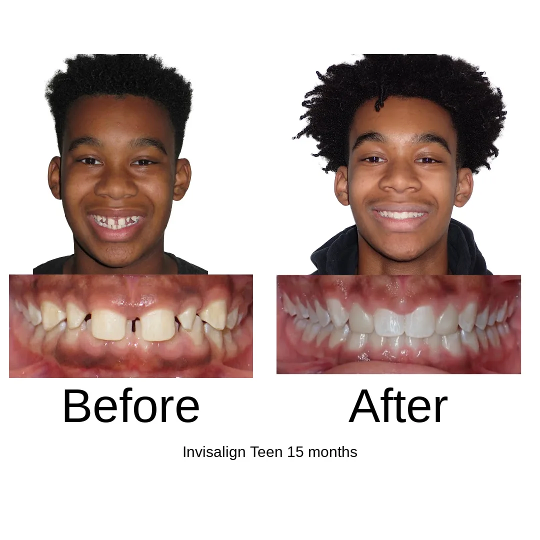 Before and after — Invisalign Teen, 15 months