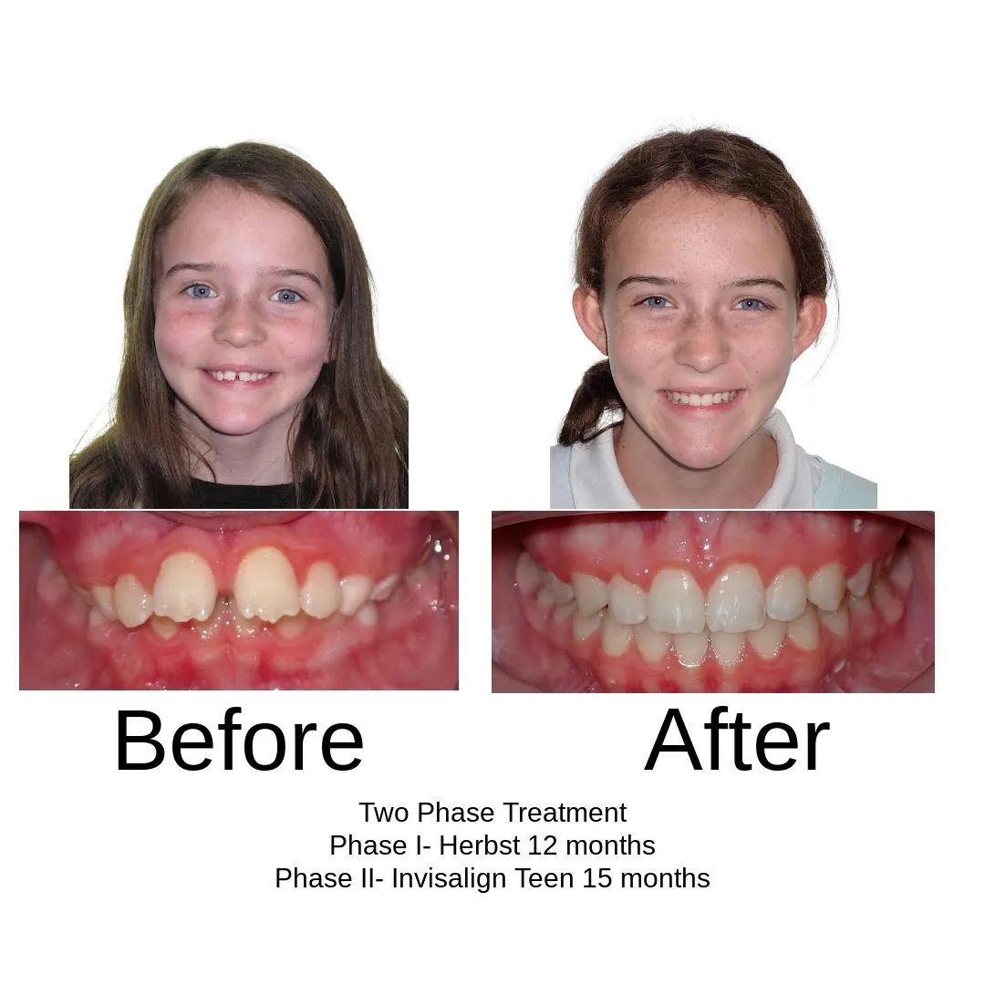 Before and after — two-phase, Herbst 12 months then Invisalign Teen 15 months